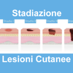 StadiazioneLesioniCutanee-EPUAP