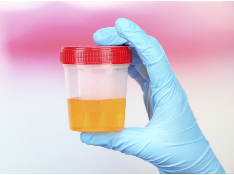 urina incolora urinari dese forme de prostatită cronică