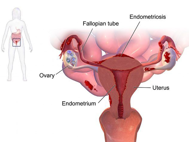 Endometriosi: 10 Crediti ECM Gratis per Infermieri e Professionisti Sanitari.