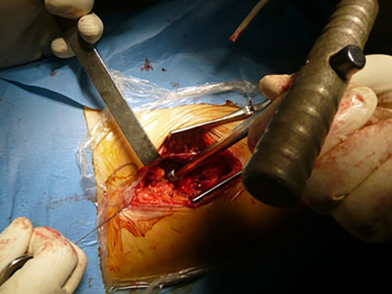 Chirurgia da record: impiantati a 108 protesi di femore, a 105 pacemaker!