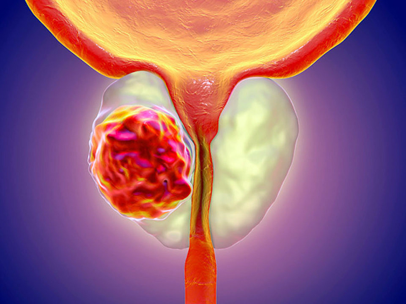prostata ingrossata tumore
