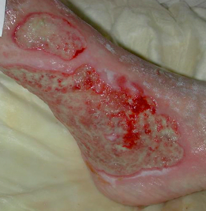 Ulcera infetta (tampone colturale positivo e segni clinici di flogosi).