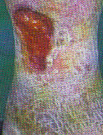 Cute perilesionale spessa, fissurata e secca: (lo scivolamento delle cellule epiteliali è molto più lento e difficoltoso).