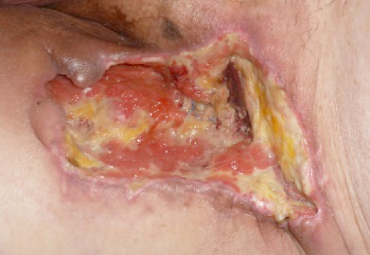Caso n. 1: lesione cutanea cronica in sede inguinale sinistra da dejescenza della ferita chirurgica per embolectomia.