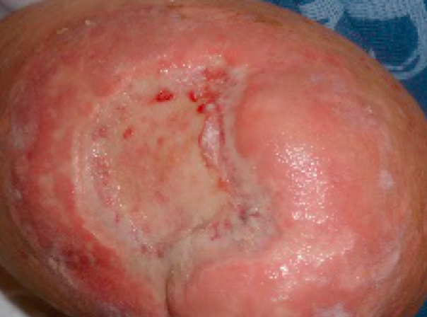 Caso n. 2: dejescenza del moncone d’amputazione di coscia in paziente con ischemia acuta inveterata dell’arto inferiore sinistro.