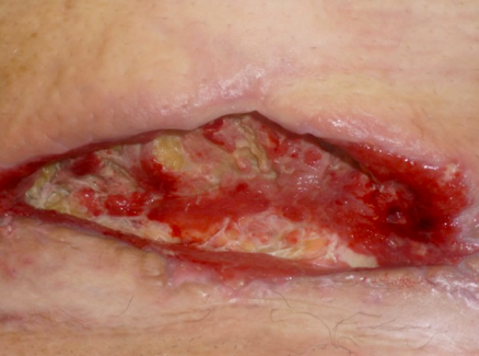 Caso n.4 a: dejescenza, dopo debridment delle escara, della sutura da taglio cesareo in paziente grande obesa.