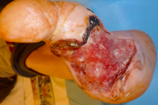 Caso n.4 c: peggioramento (si notino il letto della ferita, i margini necrotici , la cute in parte macerata).