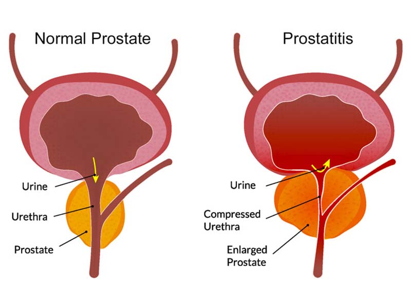 Prostatită gluteală